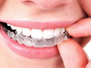 invisalign (1)